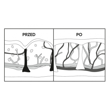 POLDERMA FALA RADIOWA MONOPOLARNA UDERZENOWA    Tanio! SS!